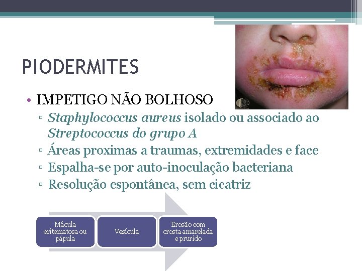 PIODERMITES • IMPETIGO NÃO BOLHOSO ▫ Staphylococcus aureus isolado ou associado ao Streptococcus do