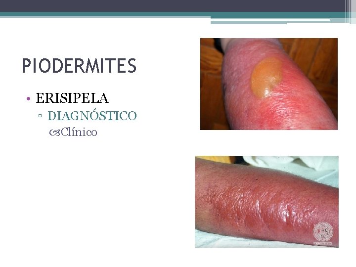 PIODERMITES • ERISIPELA ▫ DIAGNÓSTICO Clínico 