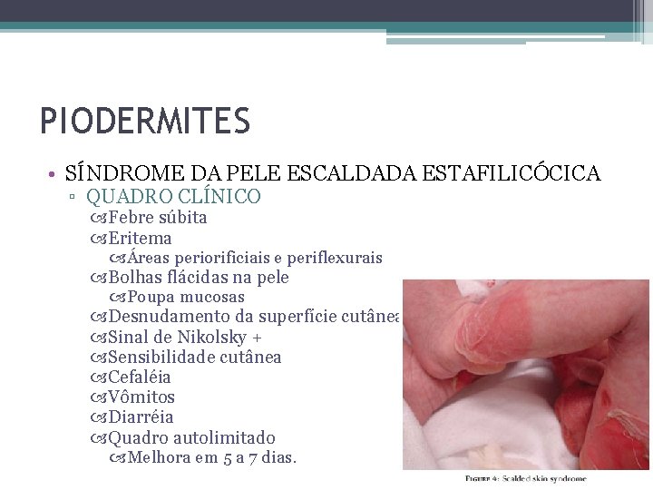 PIODERMITES • SÍNDROME DA PELE ESCALDADA ESTAFILICÓCICA ▫ QUADRO CLÍNICO Febre súbita Eritema Áreas