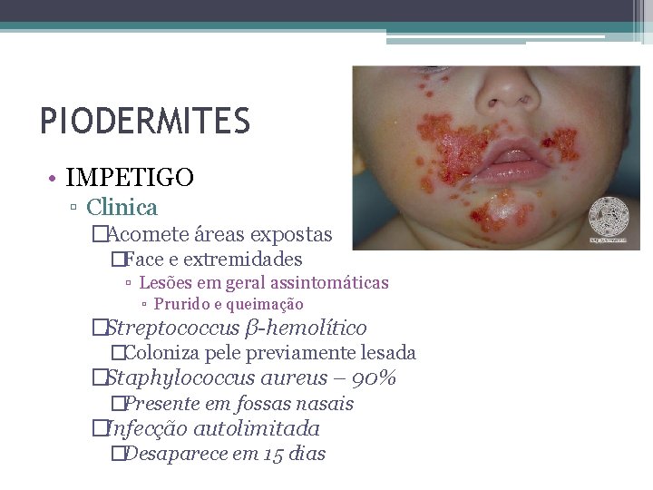 PIODERMITES • IMPETIGO ▫ Clinica �Acomete áreas expostas �Face e extremidades ▫ Lesões em