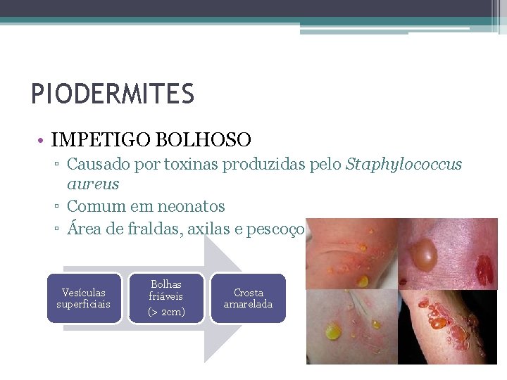 PIODERMITES • IMPETIGO BOLHOSO ▫ Causado por toxinas produzidas pelo Staphylococcus aureus ▫ Comum