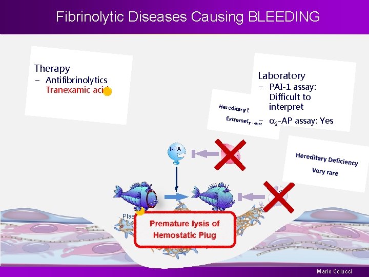 Fibrinolytic Diseases Causing BLEEDING Therapy Laboratory − Antifibrinolytics Tranexamic acid − PAI-1 assay: Difficult