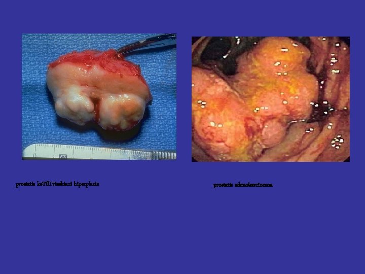 prostatis ke. Til. Tvisebiani hiperplazia prostatis adenokarcinoma 
