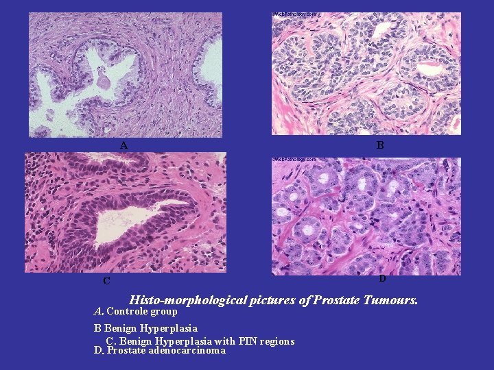 A B D C Histo-morphological pictures of Prostate Tumours. A. Controle group B Benign