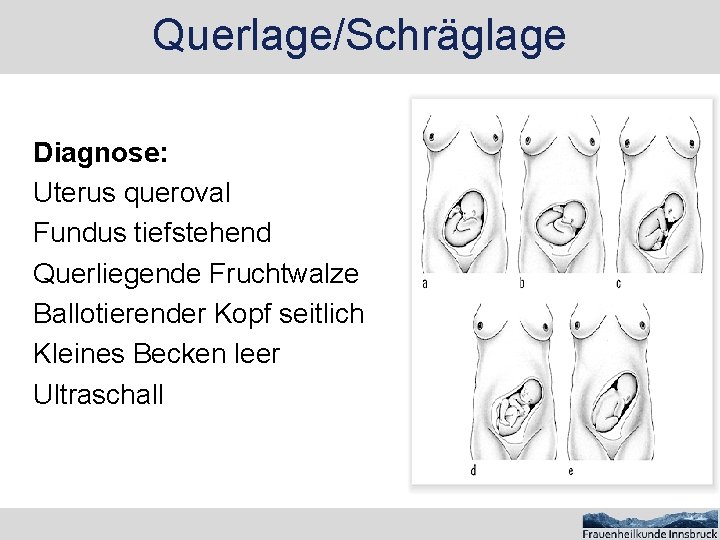 Querlage/Schräglage Diagnose: Uterus queroval Fundus tiefstehend Querliegende Fruchtwalze Ballotierender Kopf seitlich Kleines Becken leer