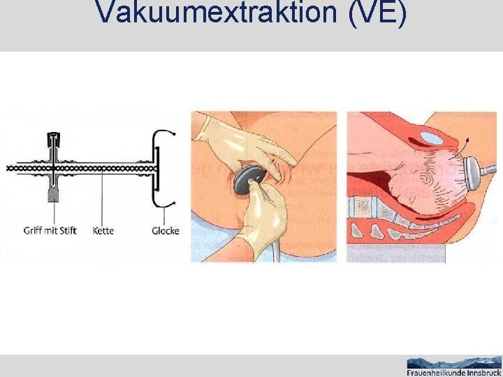 Vakuumextraktion (VE) 