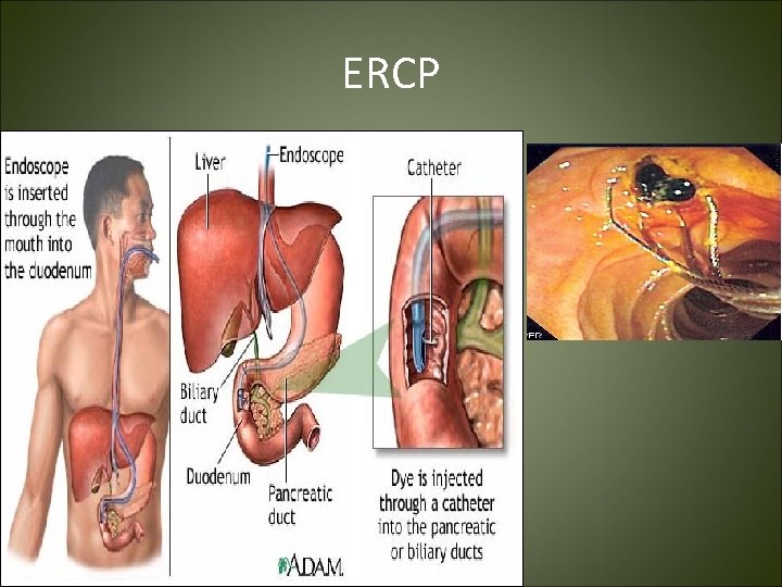 ERCP 