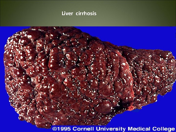 Liver cirrhosis 