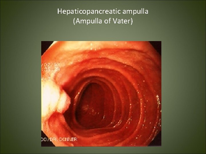 Hepaticopancreatic ampulla (Ampulla of Vater) 