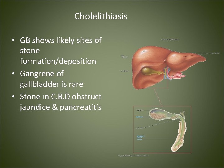 Cholelithiasis • GB shows likely sites of stone formation/deposition • Gangrene of gallbladder is