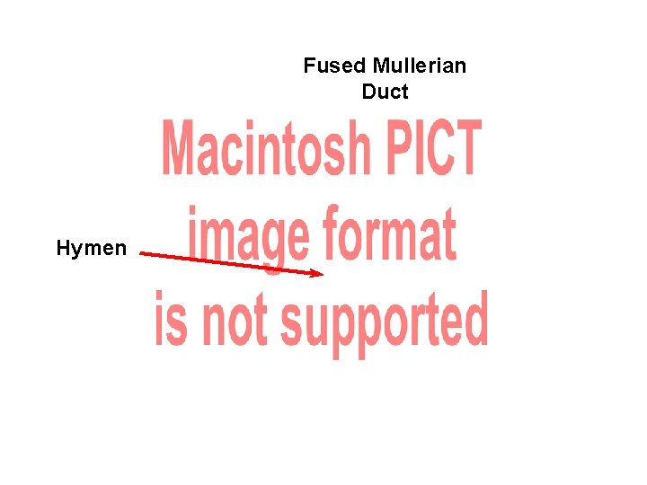 Fused Mullerian Duct Hymen 