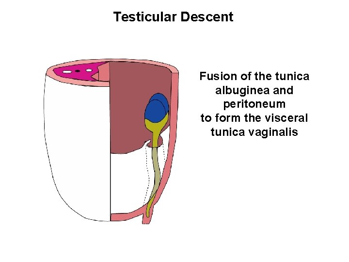 Testicular Descent Fusion of the tunica albuginea and peritoneum to form the visceral tunica