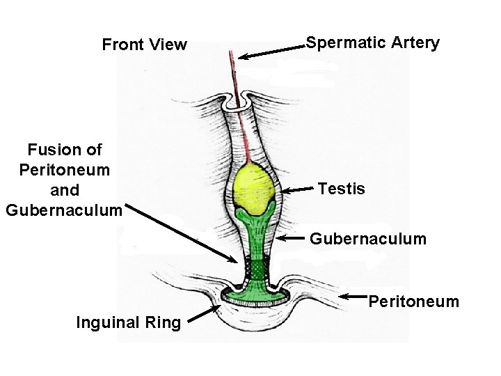 Front View Fusion of Peritoneum and Gubernaculum Spermatic Artery Testis Gubernaculum Peritoneum Inguinal Ring