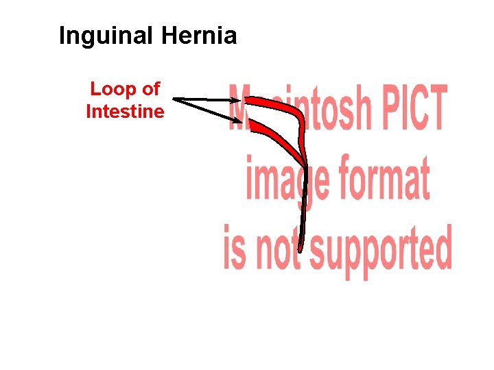 Inguinal Hernia Loop of Intestine 