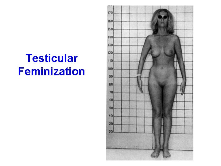 Testicular Feminization 