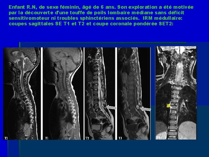 Enfant R. N, de sexe féminin, âgé de 6 ans. Son exploration a été