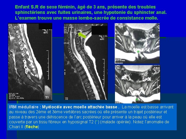 Enfant S. R de sexe féminin, âgé de 3 ans, présente des troubles sphinctériens
