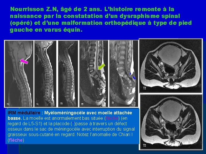 Nourrisson Z. N, âgé de 2 ans. L’histoire remonte à la naissance par la