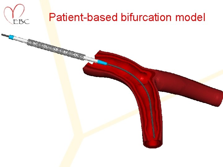 Patient-based bifurcation model 