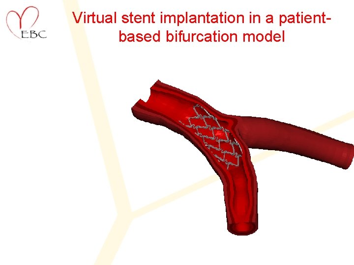 Virtual stent implantation in a patientbased bifurcation model 