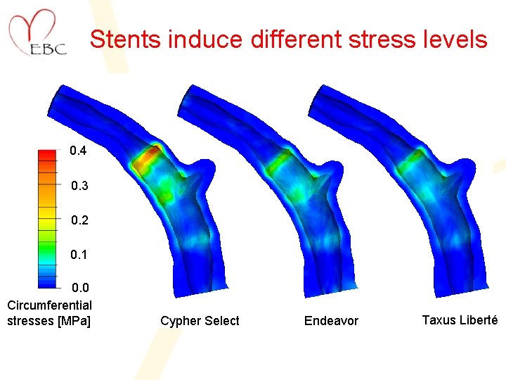 Stents induce different stress levels 0. 4 0. 3 0. 2 0. 1 0.