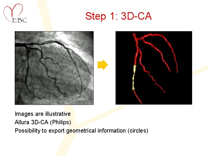 Step 1: 3 D-CA Images are illustrative Allura 3 D-CA (Philips) Possibility to export