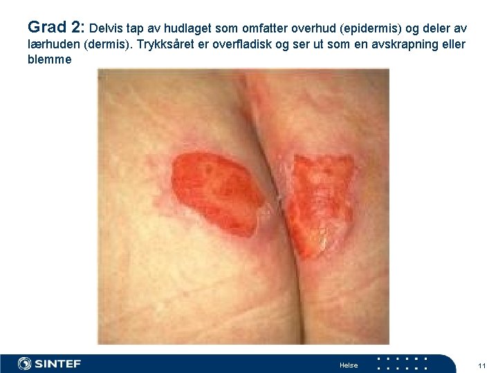 Grad 2: Delvis tap av hudlaget som omfatter overhud (epidermis) og deler av lærhuden