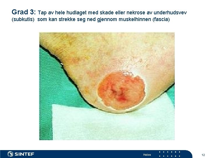 Grad 3: Tap av hele hudlaget med skade eller nekrose av underhudsvev (subkutis) som