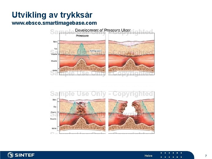 Utvikling av trykksår www. ebsco. smartimagebase. com Helse 7 