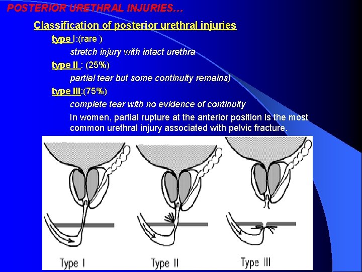 POSTERIOR URETHRAL INJURIES… Classification of posterior urethral injuries type I: (rare ) stretch injury