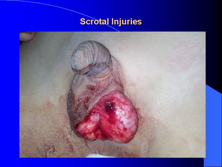 Scrotal Injuries 