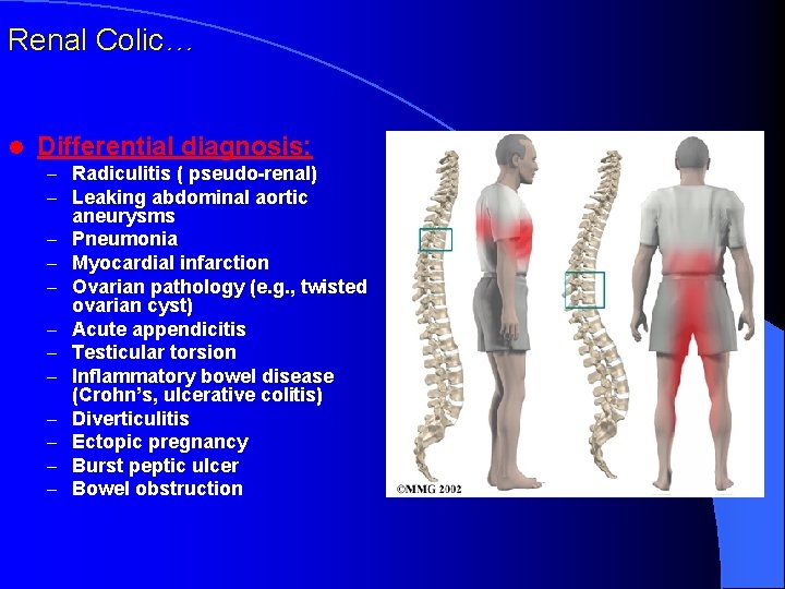 Renal Colic… l Differential diagnosis: – Radiculitis ( pseudo-renal) – Leaking abdominal aortic –