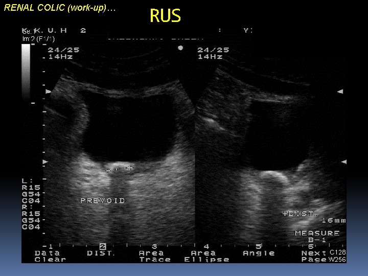 RENAL COLIC (work-up)… RUS 