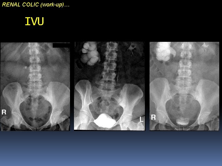 RENAL COLIC (work-up)… IVU 