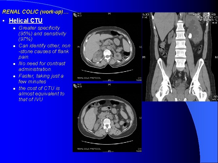 RENAL COLIC (work-up)… § Helical CTU l l l Greater specificity (95%) and sensitivity