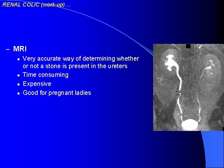 RENAL COLIC (work-up)… – MRI l l Very accurate way of determining whether or