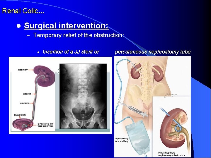 Renal Colic… l Surgical intervention: – Temporary relief of the obstruction: l Insertion of