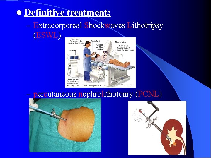 l Definitive treatment: – Extracorporeal Shockwaves Lithotripsy (ESWL). – percutaneous nephrolithotomy (PCNL) 