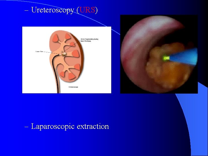 – Ureteroscopy (URS) – Laparoscopic extraction 