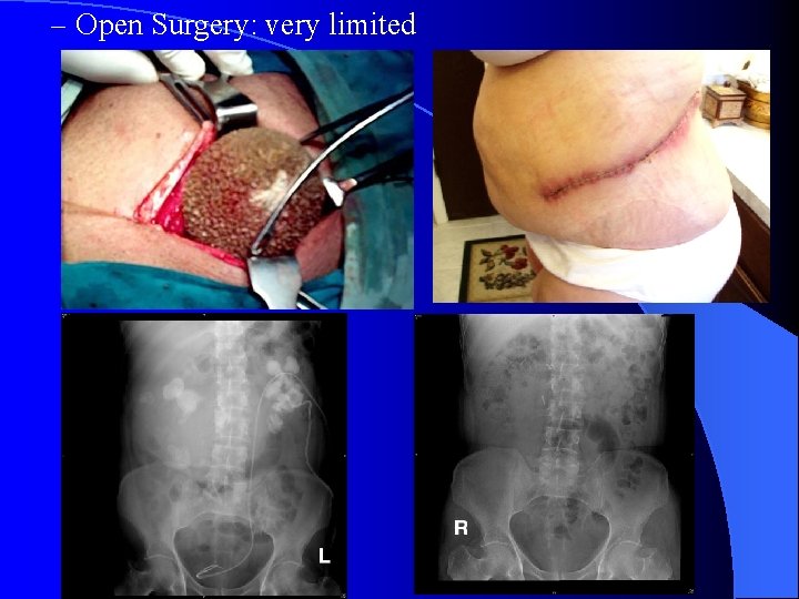 – Open Surgery: very limited 