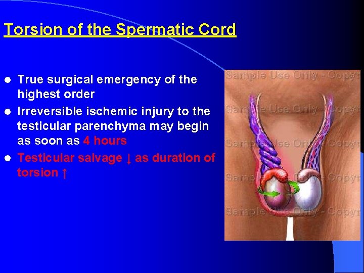 Torsion of the Spermatic Cord True surgical emergency of the highest order l Irreversible