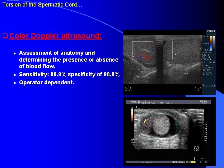 Torsion of the Spermatic Cord… q Color Doppler ultrasound: l l l Assessment of