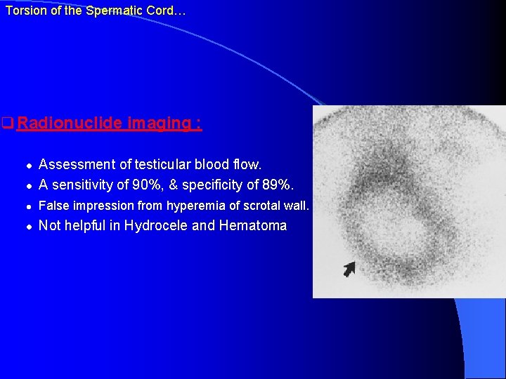 Torsion of the Spermatic Cord… q Radionuclide imaging : l Assessment of testicular blood