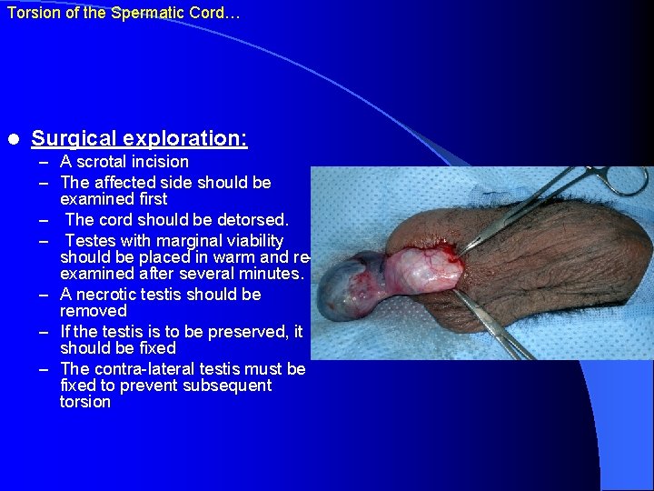 Torsion of the Spermatic Cord… l Surgical exploration: – A scrotal incision – The