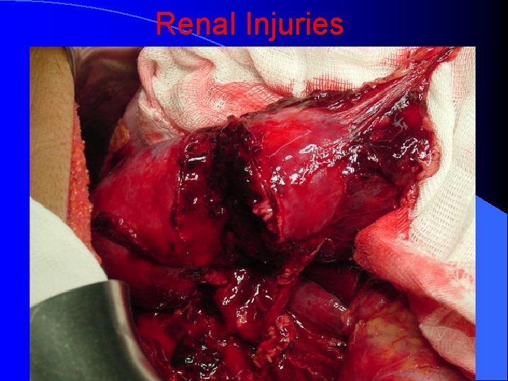 Renal Injuries 