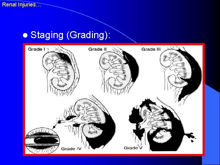 Renal Injuries… l Staging (Grading): 