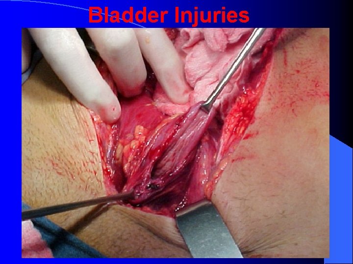 Bladder Injuries 