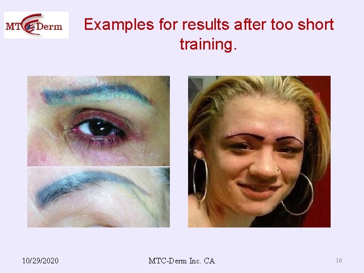 Examples for results after too short training. 10/29/2020 MTC-Derm Inc. CA 16 