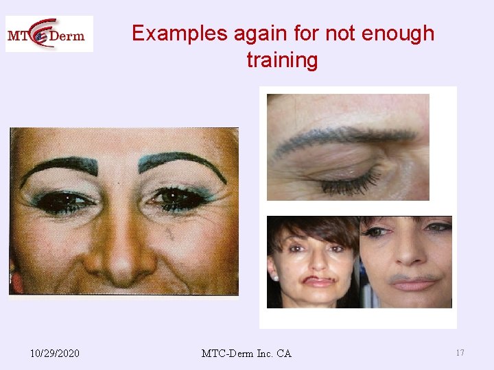 Examples again for not enough training 10/29/2020 MTC-Derm Inc. CA 17 