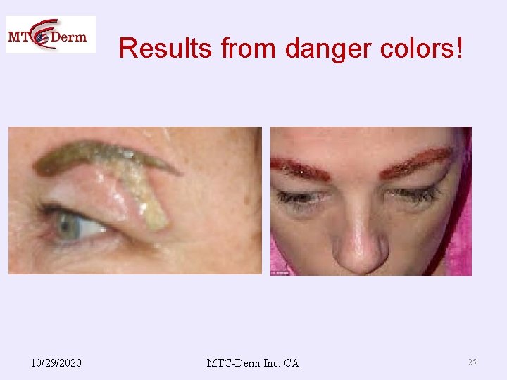 Results from danger colors! 10/29/2020 MTC-Derm Inc. CA 25 